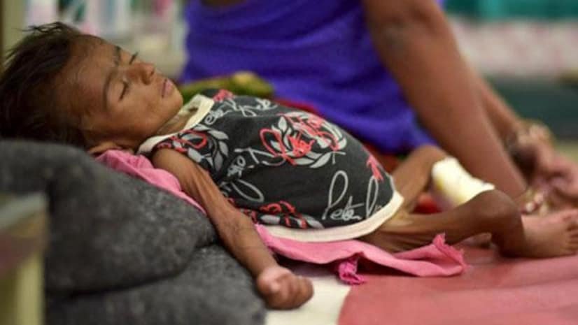 Child Malnutrition: India’s Failing Battle Against Child Hunger 3 Child Malnutrition 1